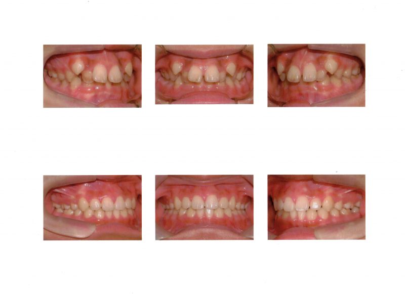 八重歯と矯正 医院ブログ